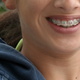 Image for article titled Girls Are More Likely Than Boys to Hate Their Teeth and Want Braces